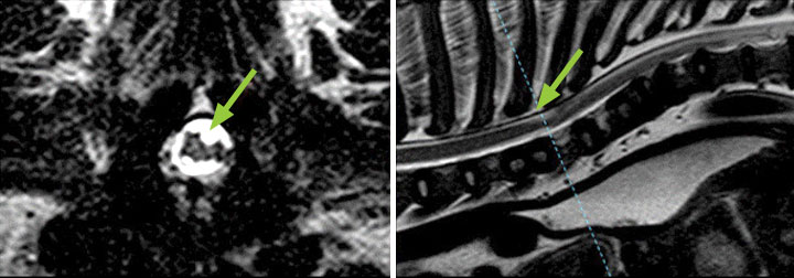 Figure 1: Transverse (left) and sagittal (right) T2w images at the level of the cranial thoracic spine. The transverse picture represents the point of maximal compression of the spinal arachnoid diverticula (arrow