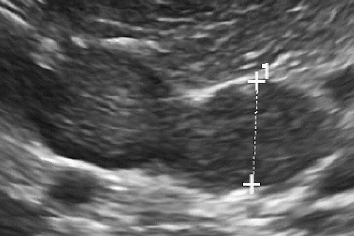 Figure 1: Abdominal ultrasound showing adrenomegaly in a dog with pituitary dependent HAC. 