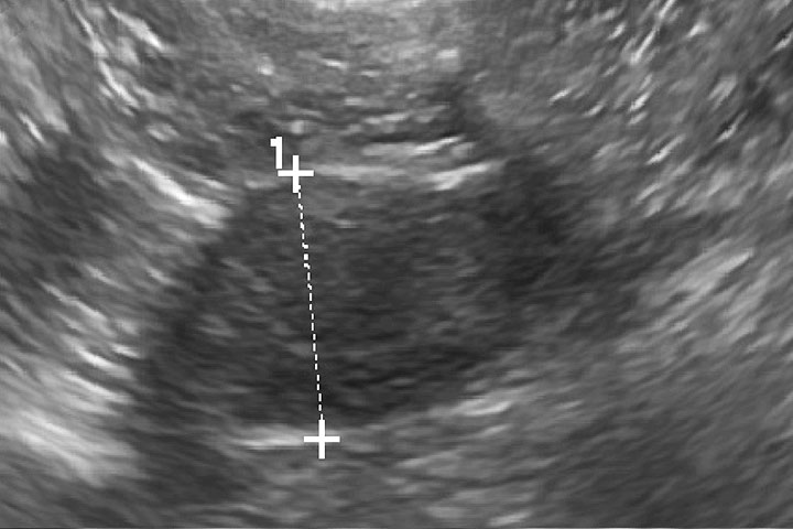 Figure 2: Abdominal ultrasound showing right sided adrenal mass in a dog with adrenal dependent HAC.