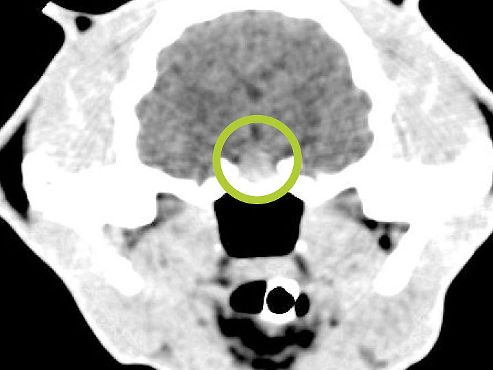 CT scan of the brain showing an enlarged pituitary lesion (circled)