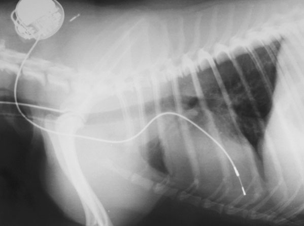 A radiograph of a pacemaker implantation showing the lead coursing from the heart up the cranial vena cava to the jugular vein and then subcutaneously back to the generator.
