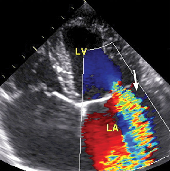 The same image as above, with the computer colour coding showing the direction of blood flow. When the left ventricle (LV) pumps, the mitral valve should prevent any backflow. In this instance there is a jet of blood regurgitating back into the left atrium (LA).