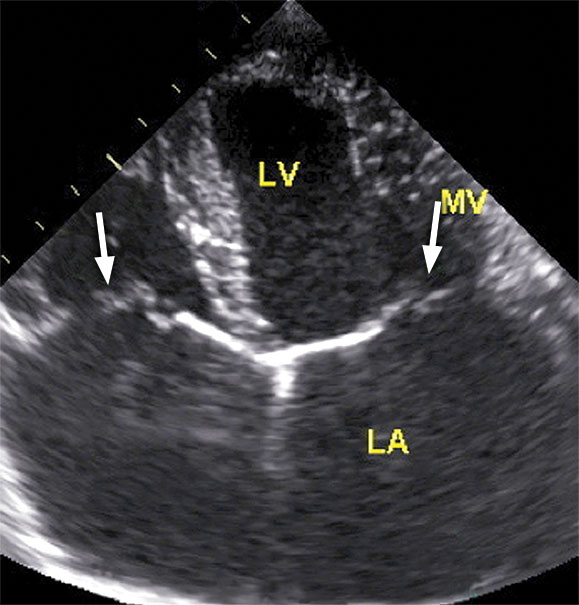 An ultrasound image showing a dog’s heart; each of the chambers are labelled. Blood flow from the left atrium (LA) is upwards through the mitral valve (MV) and into the left ventricle (LV). The mitral valve acts as a one-way valve.