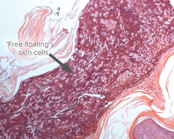 Figure 3: Biopsied skin showing the pale free floating cells that have lost their intercellular links in a case of pemphigus foliaceus