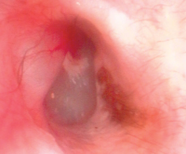 Figure 1: The normal tympanic membrane (ear drum) of a dog