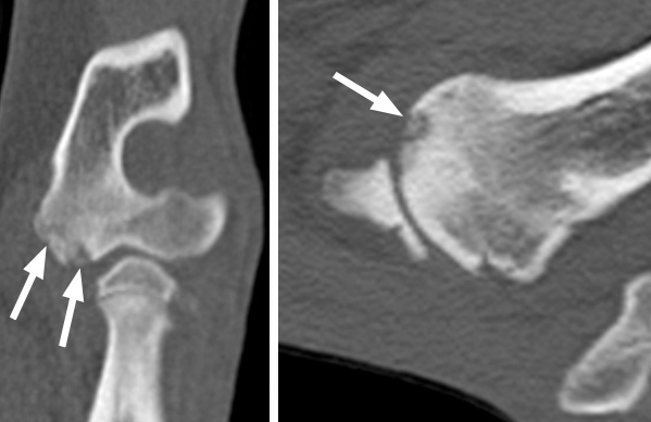On these CT scans you can see a small erosion (arrows) on the end of the humerus (the bone of the upper limb) just above the elbow joint. This is a disease called elbow osteochondrosis, often seen in young animals. This would have been very difficult or impossible to see on normal X-rays.