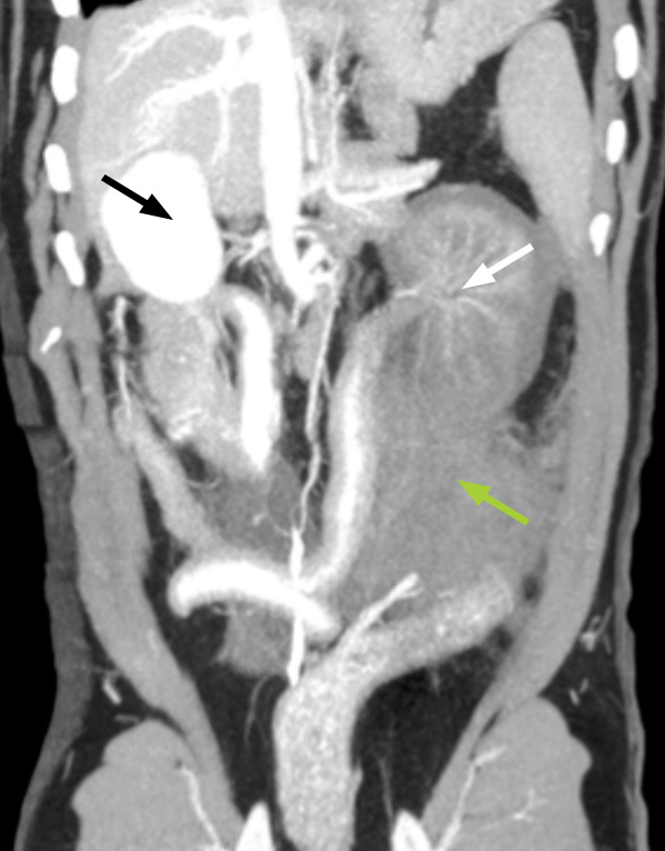 This CT image of a dog's abdomen, obtained after injecting contrast agent (dye), shows a normal right kidney (the white structure on the left of the image – black arrow) and a kidney on the right of the image that has a reduced blood supply (white arrow). This dog had been hit by a car with the result that the left kidney has been torn off its blood supply – the normal contrast or dye (which shows as white) is not present in the abnormal left kidney to the same degree as in the normal right kidney. The grey material (green arrow) near the affected left kidney is blood from the severed artery. The patient made a full recovery after surgery.