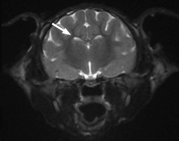 Another MRI scan of the brain (arrow) This view is a cross-section seen from the back