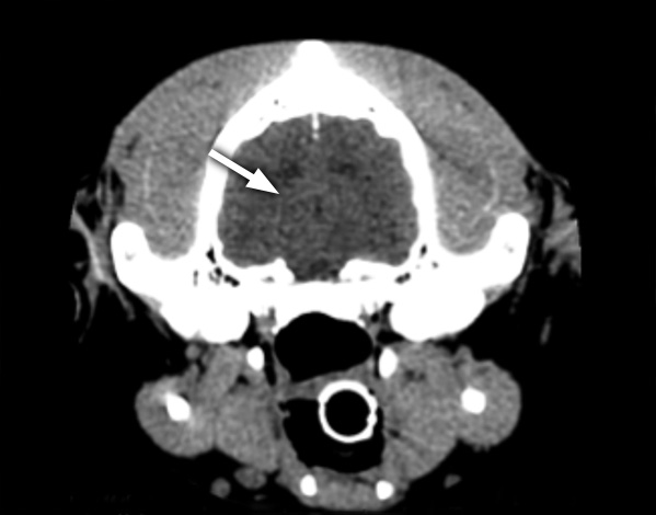 A CT scan of a brain (arrow), again showing much less detail than the MRI scan.  This view is a cross-section seen from the back (the skull around the brain is shown as bright white)