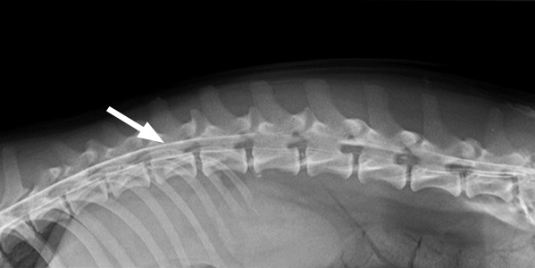 An myelogram of the spine showing dye, seen as white on the X-ray (arrow) injected around the spinal cord