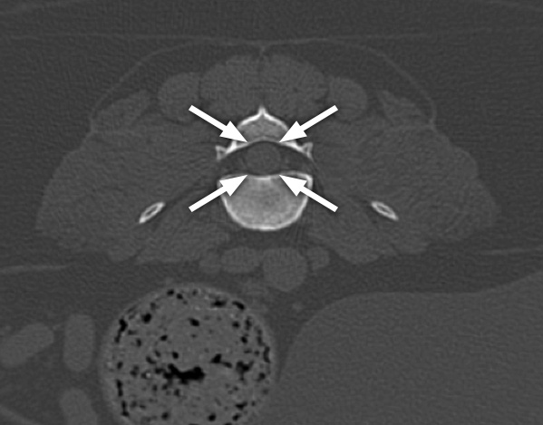 A CT scan of the spine showing a cross section through a vertebra (seen as white) with the spinal cord (arrowed) in the middle of the bone