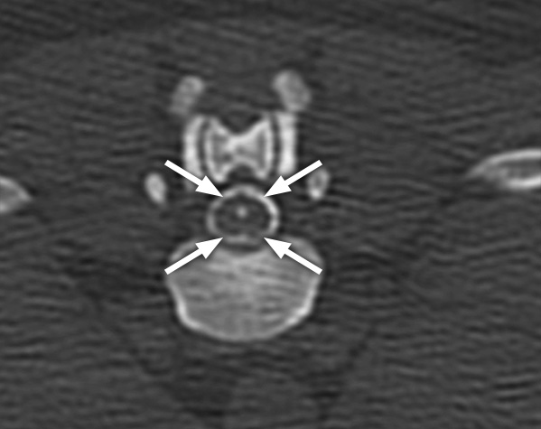 A CT myelogram with dye (seen as white) injected around the spinal cord (arrows)
