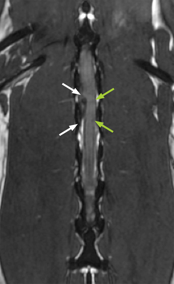 MRI scan of the spinal cord (this time in a slice viewed from above), showing slipped disc material (white arrows) bulging out and pressing against the spinal cord (green arrows), with no need for dye injection