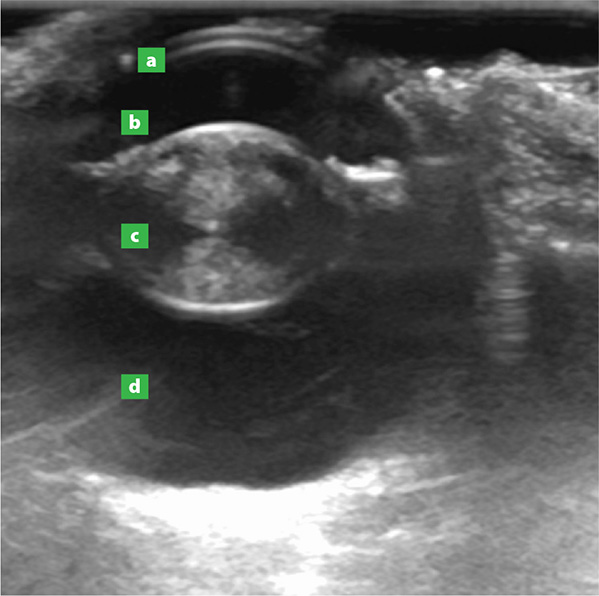 An ultrasound image of an eye showing a cataract in the lens (c). The cornea (a) and the fluid/jelly-filled segments of the eye (b and d) are also visible.