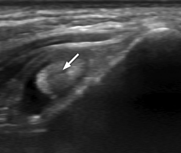 Ultrasound image of an abnormal biceps tendon (arrow) with fluid around it (showing as black).