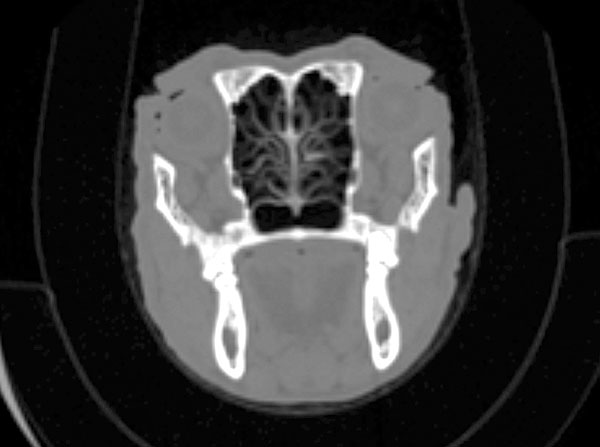 CT scan of a normal nasal cavity, showing a slice across the nose from one side to the other