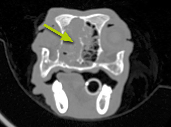 CT scan of a nasal tumour: the tumour (arrowed) has destroyed the bones in the nose