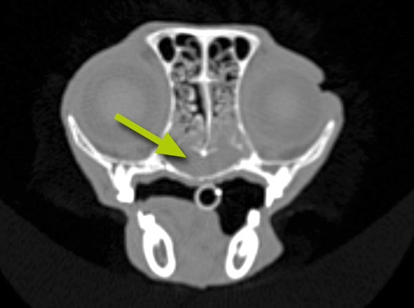 CT scan of lymphoplasmacytic (allergic) rhinitis: there is an increased amount of fluid in the nose. This shows as grey on the scan (arrow)