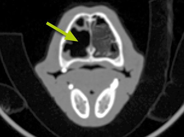 CT scan of fungal infection (Aspergillus): there is destruction of the small bones in the nose, leaving behind an air-filled area which shows as black on the scan (arrow)