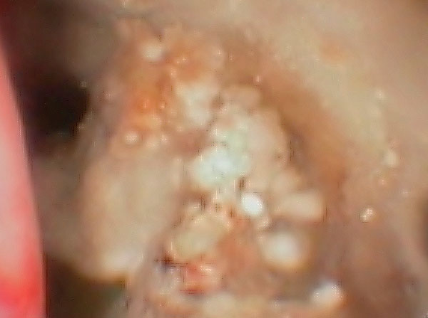 Fungus (Aspergillus) seen as whitish clumps inside a dog’s nose during rhinoscopy (a camera inspection)