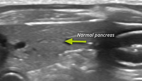 The normal canine pancreas. It is a similar shade of grey to the surrounding fat.