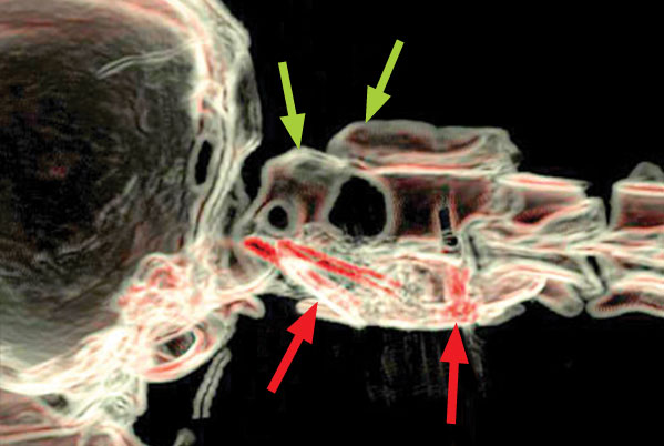 CT scan after the operation showing the two vertebrae back together again (blue arrows) The screws are visible and show as red on this image (indicated by red arrows) and they are supported by a plug of cement under the bones