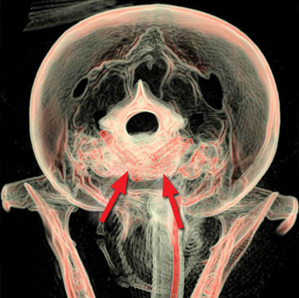 A CT scan looking from behind the skull, showing the screws in the bones from a different angle (indicated by arrows)s