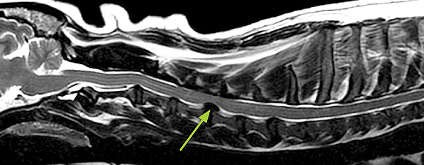 MRI scan showing a slipped disc in the neck