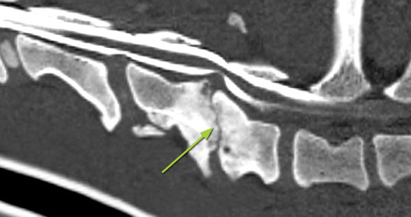 CT-myelogram in a dog showing deformed vertebrae with collapse of the disc space, protrusion of the disc, and spinal cord compression