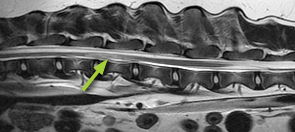 MRI scan showing an ischaemic myelopathy (FCE) in the back (arrow)