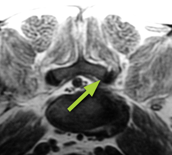 MRI scan across the spine showing lumbosacral stenosis due to a protruding (bulging) disc that is compressing the nerves on this side of the spine (arrow)