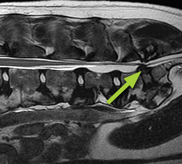 MRI scan along the length of the spine showing lumbosacral stenosis due to a protruding (bulging) disc (arrow)