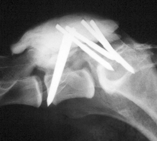 X-ray following lumbosacral stenosis surgery showing multiple pins embedded in cement that were used to stabilise the spine