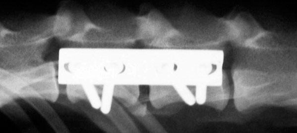 Luxated (dislocated) vertebrae in the back that have been stabilised with a plate and four screws