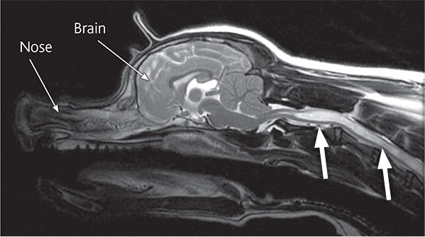 An MRI scan of a patient with syringomyelia. The fluid build up in the spinal cord shows as almost white (white arrows).