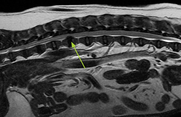 MRI scan showing a slipped disc in the back