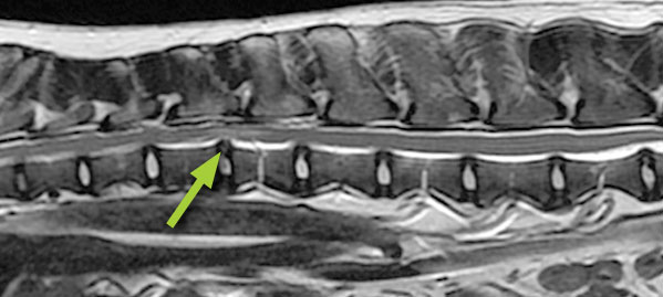 MRI scan showing a traumatic disc extrusion in the back (arrow)