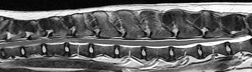 Traumatic disc extrusion  (traumatic ‘slipped disc’)