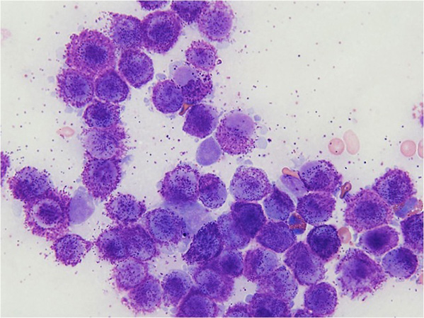 Mast cells from an aspirate, seen under the microscope – they contain and shed typical granules. They are stained purple in this sample.