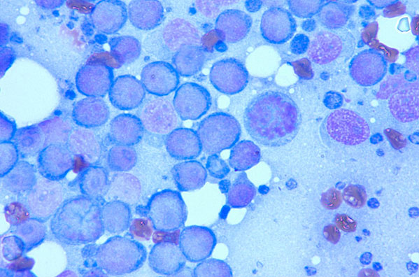 A fine needle aspirate sample of lymphoma cells seen under the microscope