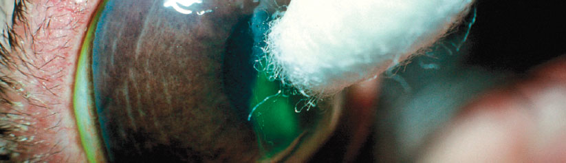 Recurrent corneal erosions (indolent ulcers)