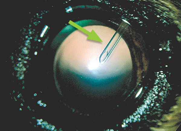 Glaucomatous eye with implanted tube (marked with an arrow). The pressure in this eye is controlled