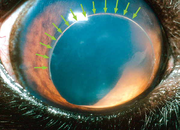 A dislocated (luxated) lens in the front chamber of the eye. The arrows mark the edge of the lens