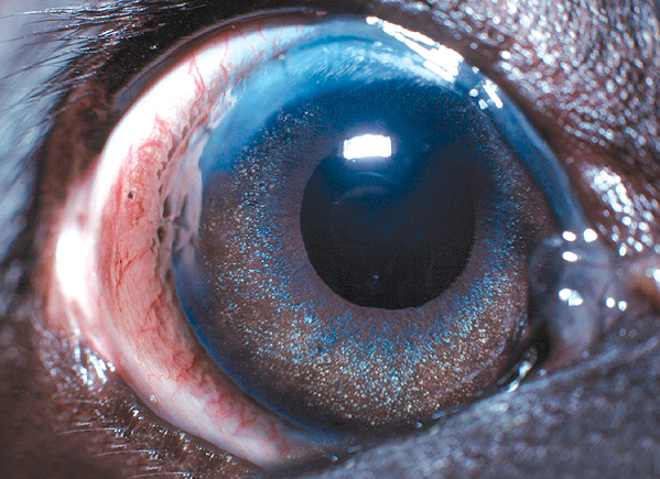 A visual eye following lens removal. Notice the faint scar at the top of the eye