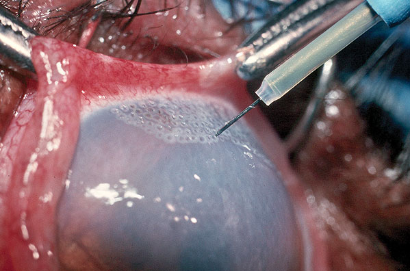 An eye undergoing thermokeratoplasty. The procedure is carried out under general anaesthesia.