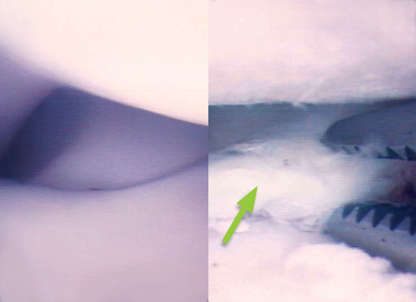 Normal elbow joint and an elbow with a fragmented coronoid process being removed with forceps (arrow)