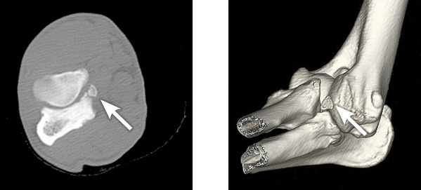 CT scans showing a fragment of bone in the elbow joint (arrows)