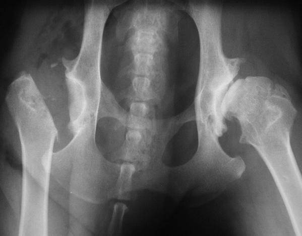 X-ray showing femoral head removal