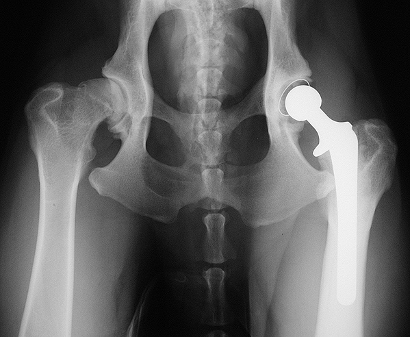 X-ray showing total hip replacement