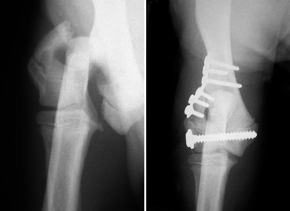 Fracture of the outside (lateral) aspect of the humeral condyle repaired with a plate and screws